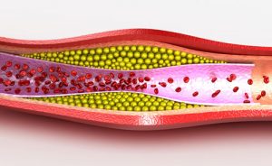 Cholesterol plaque